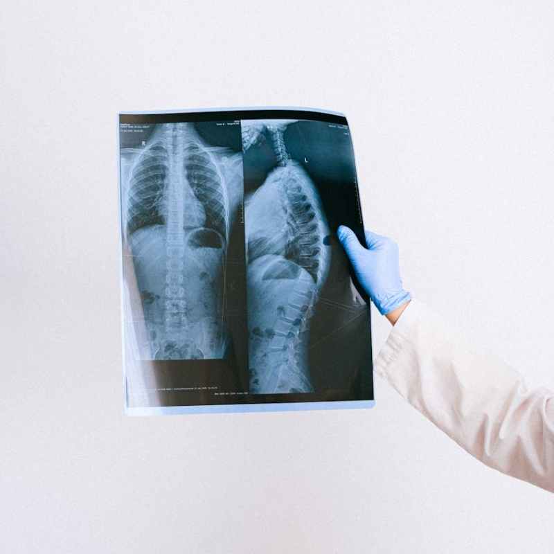 Visceroptosis & mesenteric ischemia diagnosed&nbsp;(2021)